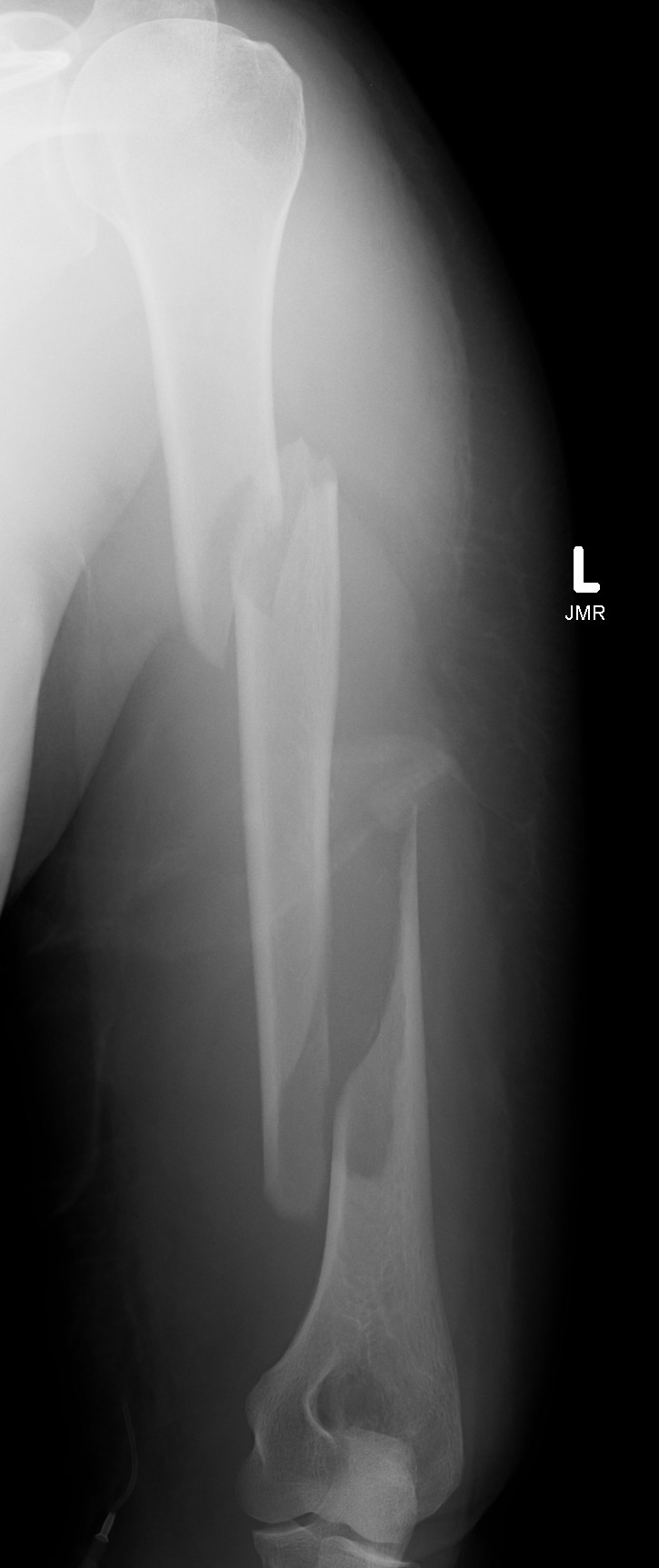 Humeral Fracture Segmental